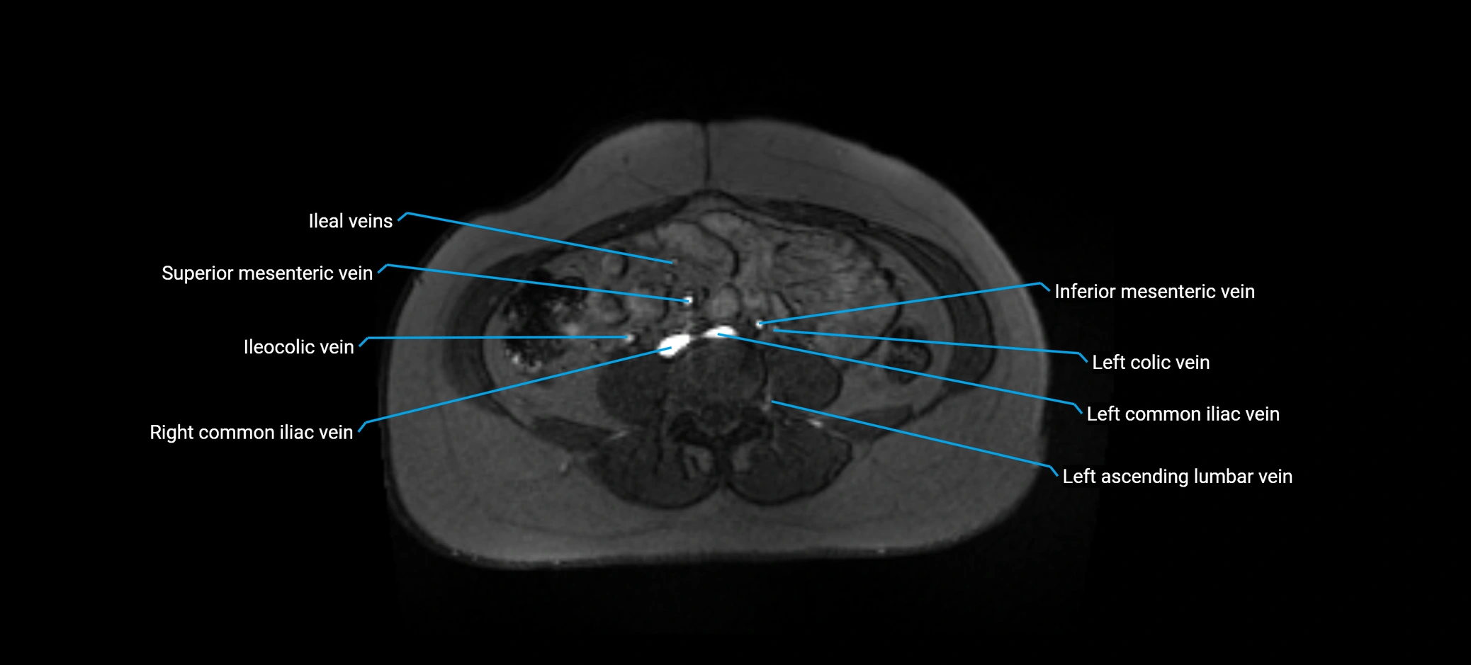 MRV abdomen pelvis & lower limb axial cross sectional anatomy labelled MRI image 113 (1).webp